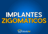 #138 Implantes zigomáticos